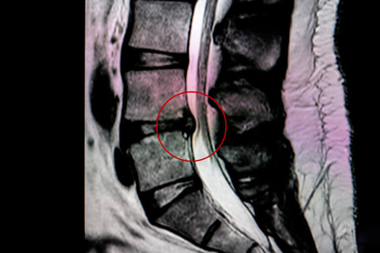 MRI scan of lateral lumbar vertebral column showing L4-L5 disc herniation